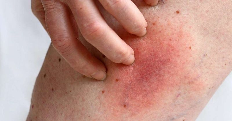 Low Immediate Risk Does Not Mean No Sting Risk